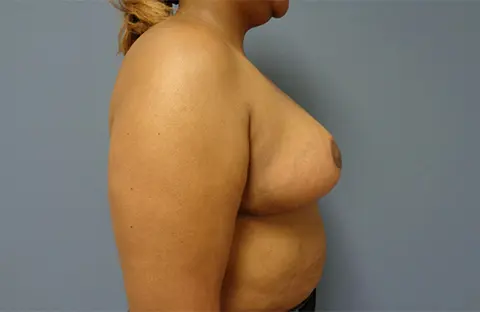 Breast Reduction Before & After Pictures Nashville, TN