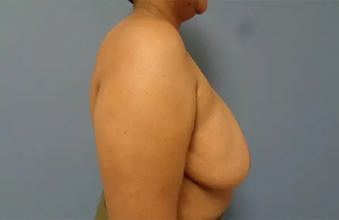 Breast Reduction Before & After Pictures Nashville, TN
