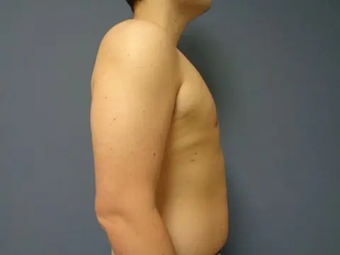 Gynecomastia Before & After Pictures Nashville, TN