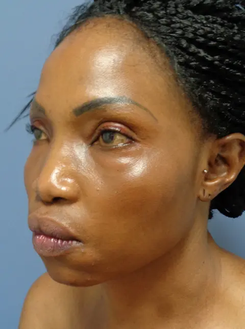 Rhinoplasty Before & After Pictures Nashville, TN