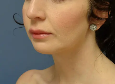 Chin Augmentation Before & After Pictures Nashville, TN