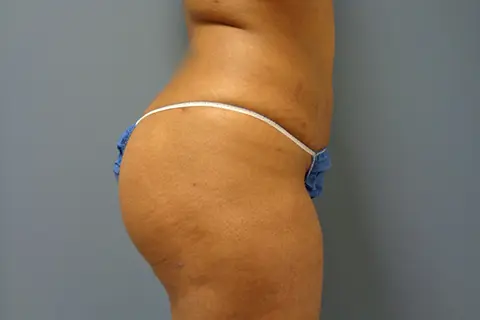 Butt Augmentation Before And After Pictures Nashville, TN