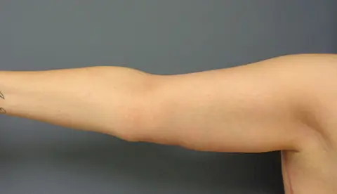 Arm Lift Before & After Pictures Nashville, TN