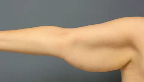 Arm Lift Before & After Pictures Nashville, TN