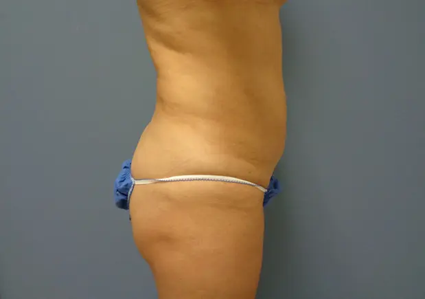 Tummy Tuck Before & After Pictures in Nashville, TN