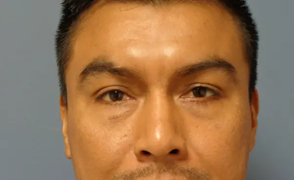 Blepharoplasty Before & After Pictures in Nashville, TN