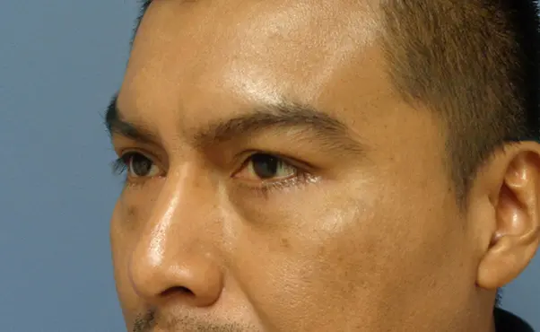 Blepharoplasty Before & After Pictures in Nashville, TN