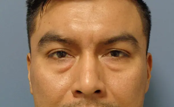 Blepharoplasty Before & After Pictures in Nashville, TN
