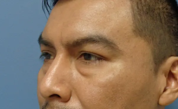 Blepharoplasty Before & After Pictures in Nashville, TN