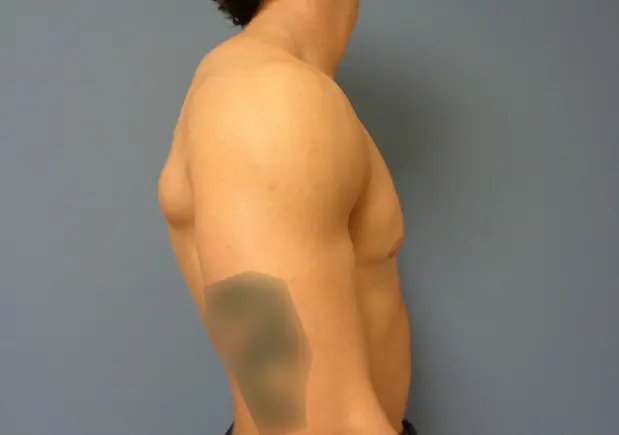 Gynecomastia Before & After Pictures in Nashville, TN