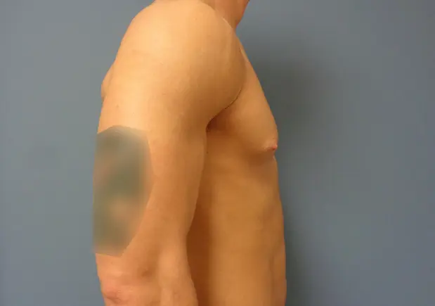 Gynecomastia Before & After Pictures in Nashville, TN