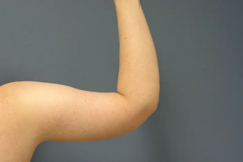 Arm Lift Before & After Pictures in Nashville, TN