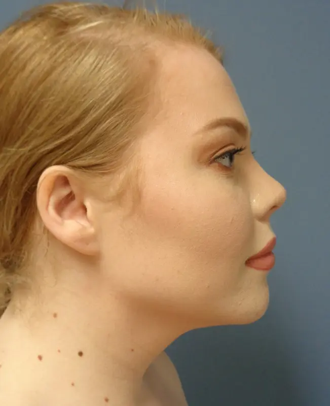 Liposuction Before & After Pictures in Nashville, TN