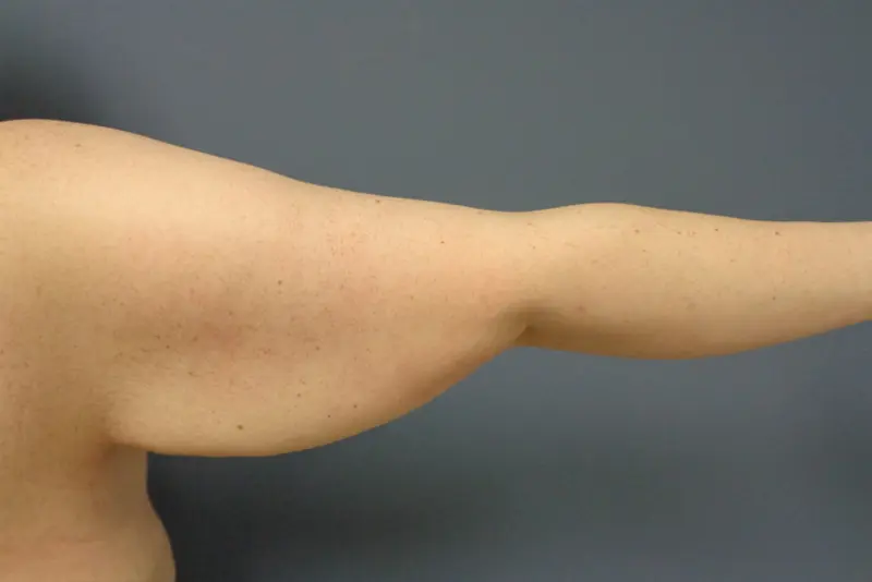 Arm Lift Before & After Pictures in Nashville, TN