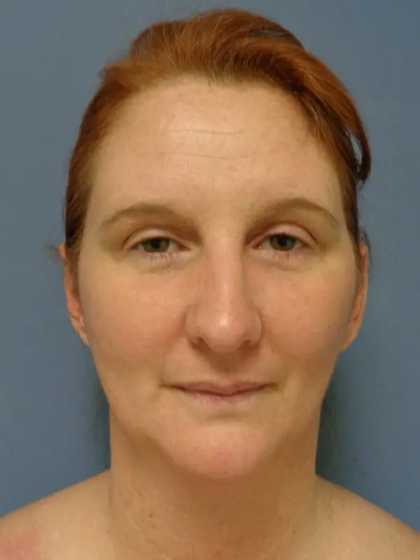 Otoplasty Before & After Pictures in Nashville, TN