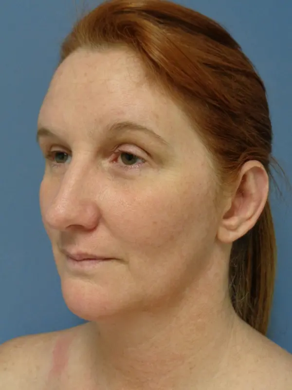 Otoplasty Before & After Pictures in Nashville, TN