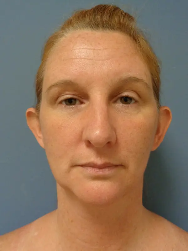 Otoplasty Before & After Pictures in Nashville, TN