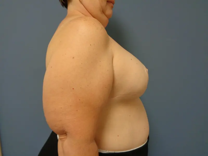 Breast Reconstruction Before & After Pictures in Nashville, TN