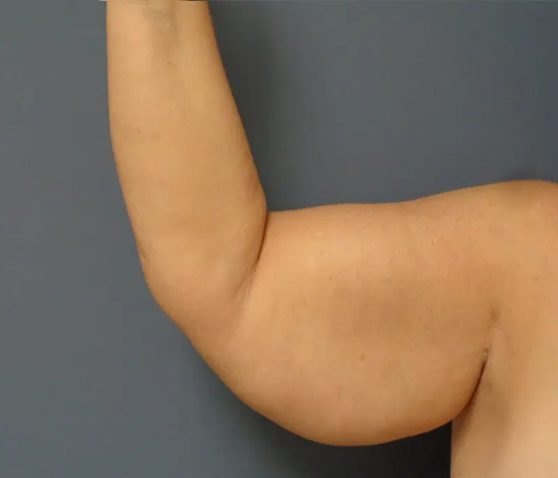 Arm Lift Before & After Pictures in Nashville, TN