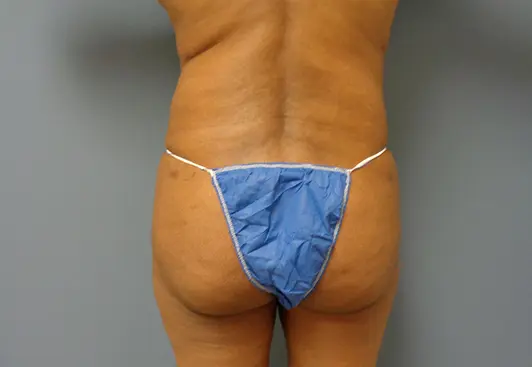 Liposuction Before and After Pictures Nashville, TN