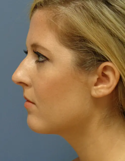 Rhinoplasty Before and After Pictures Nashville, TN