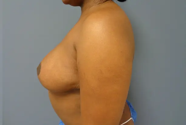Breast Augmentation with Lift Before and After Pictures Nashville, TN