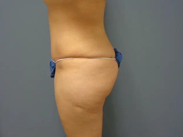 Abdominoplasty - Tummy Tuck Before and After Pictures Nashville, TN