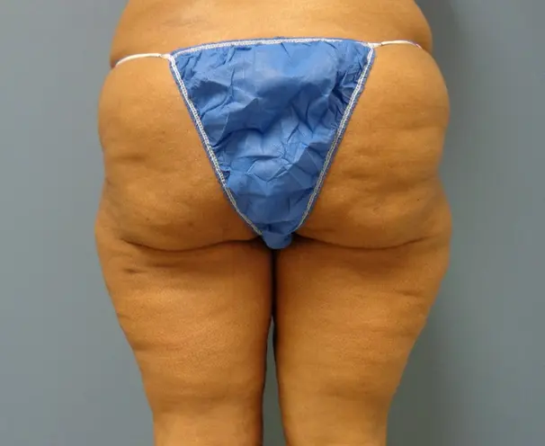 Thigh Lift Before and After Pictures Nashville, TN