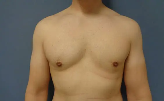 Gynecomastia Before & After Pictures in Nashville, TN