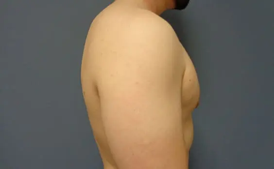 Gynecomastia Before & After Pictures in Nashville, TN