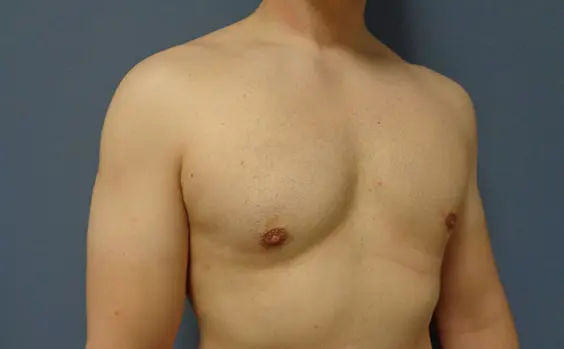 Gynecomastia Before & After Pictures in Nashville, TN