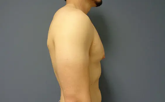 Gynecomastia Before and After Pictures Nashville, TN