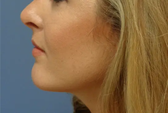Chin Augmentation Before and After Pictures Nashville, TN
