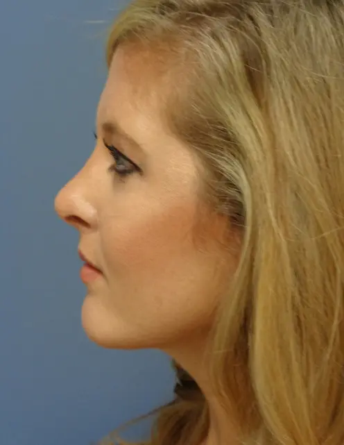 Rhinoplasty Before and After Pictures Nashville, TN