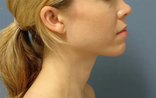 Chin Augmentation Before and After Pictures Nashville, TN