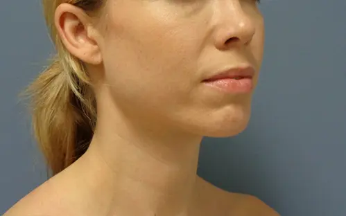 Chin Augmentation Before and After Pictures Nashville, TN
