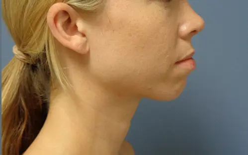 Chin Augmentation Before and After Pictures Nashville, TN