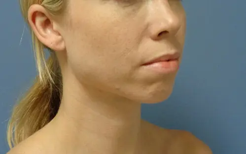 Chin Augmentation Before and After Pictures Nashville, TN
