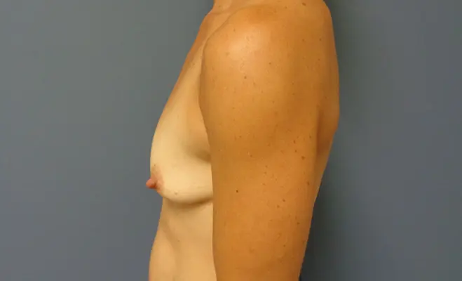 Breast Augmentation with Lift Before and After Pictures Nashville, TN
