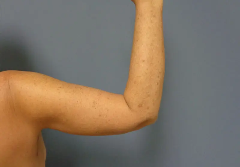 Arm Lift Before and After Pictures Nashville, TN