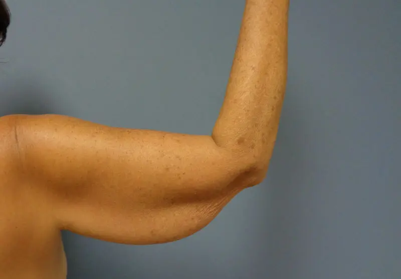 Arm Lift Before and After Pictures Nashville, TN