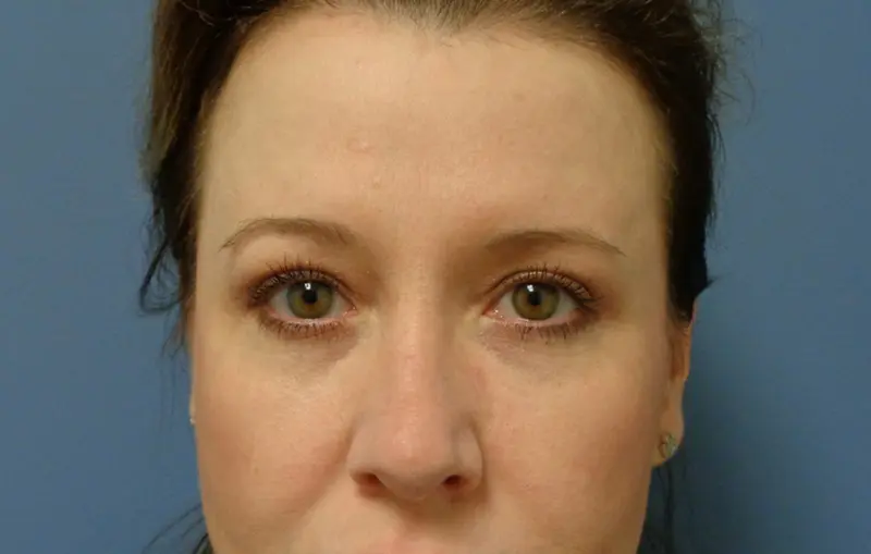 Blepharoplasty Before & After Pictures in Nashville, TN