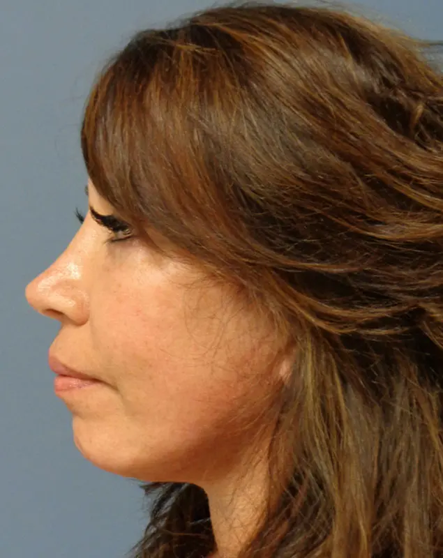 Facelift Before and After Pictures Nashville, TN