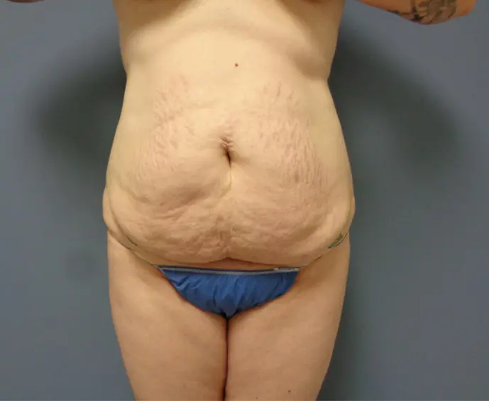 Tummy Tuck Before and After Pictures Nashville, TN