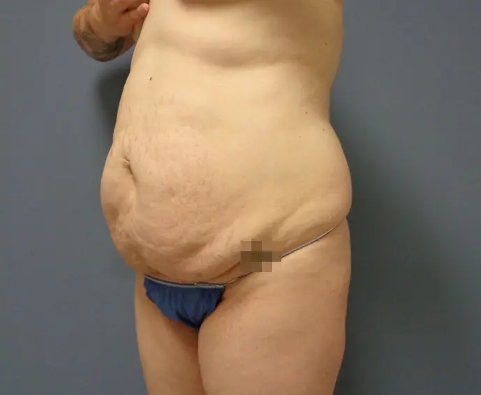 Abdominoplasty Before & After Pictures in Nashville, TN