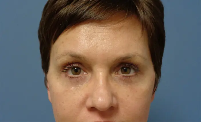 Blepharoplasty Before and After Pictures Nashville, TN