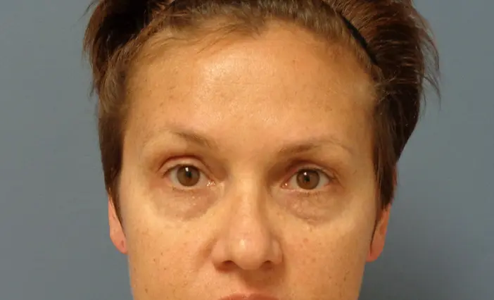 Blepharoplasty Before and After Pictures Nashville, TN