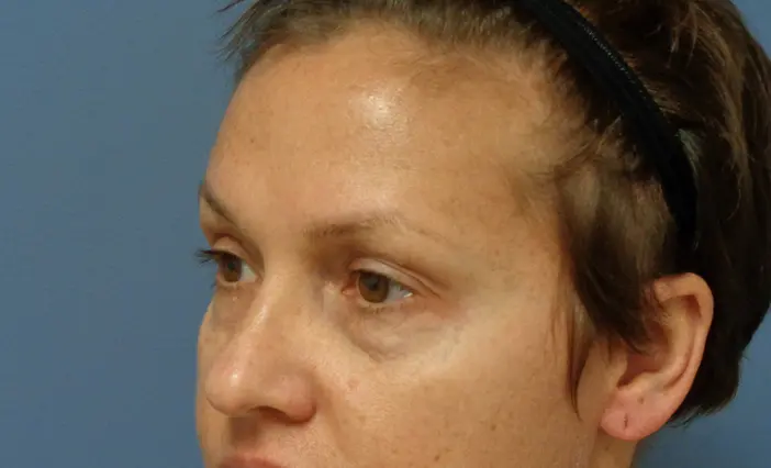 Blepharoplasty Before and After Pictures Nashville, TN