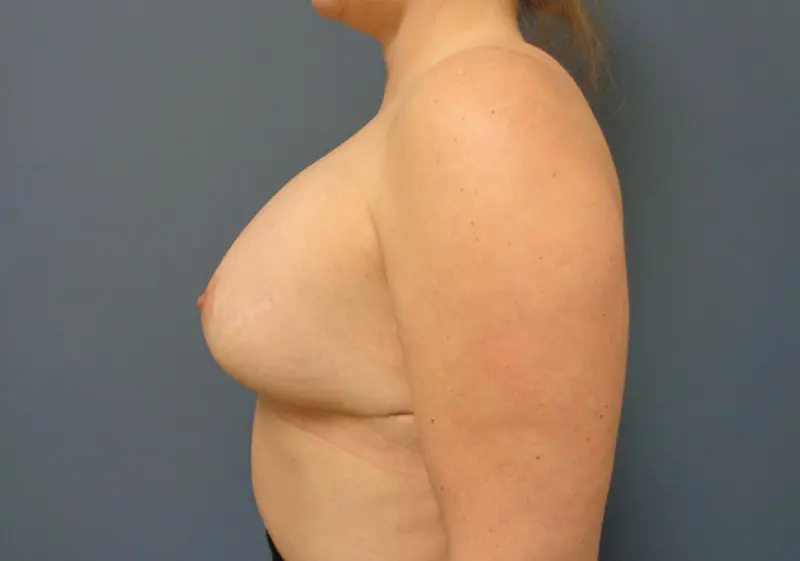 Implant Exchange/Removal Before and After Pictures Nashville, TN
