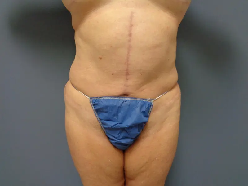 Tummy Tuck Before and After Pictures Nashville, TN
